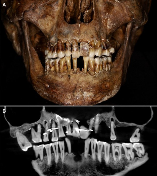 Зубные протезы 17-го века спасли репутацию многих французских аристократов 