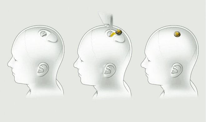 Илон Маск представил рабочий прототип прорывного мозгового импланта Neuralink 